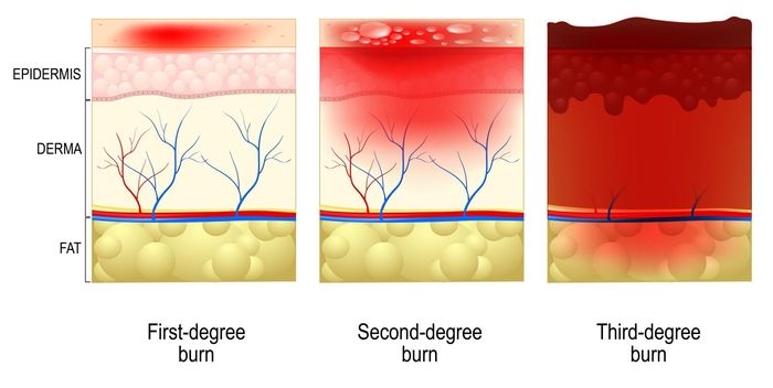 Classifications (Degrees) of Burn Injuries